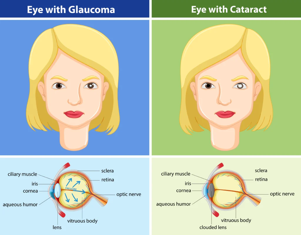 Glaucoma in india